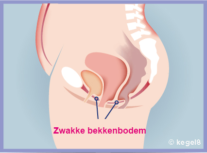zwangerschap, zwakke bekkenbodem, vpwijchen